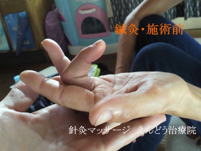 指の屈筋腱断裂損傷・鍼灸施術前